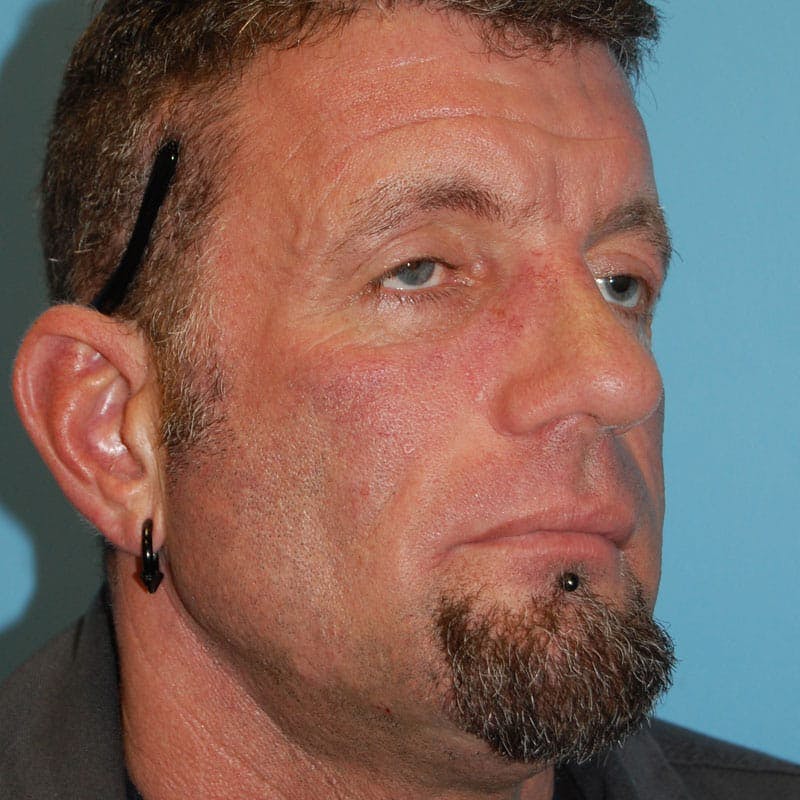 Male Rhinoplasty Before & After Gallery - Patient 821686 - Image 6