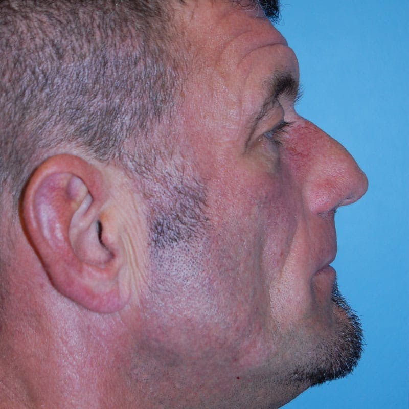 Male Rhinoplasty Before & After Gallery - Patient 821686 - Image 5
