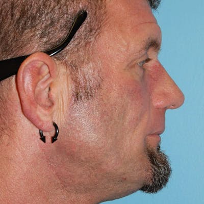 Male Rhinoplasty Before & After Gallery - Patient 821686 - Image 2