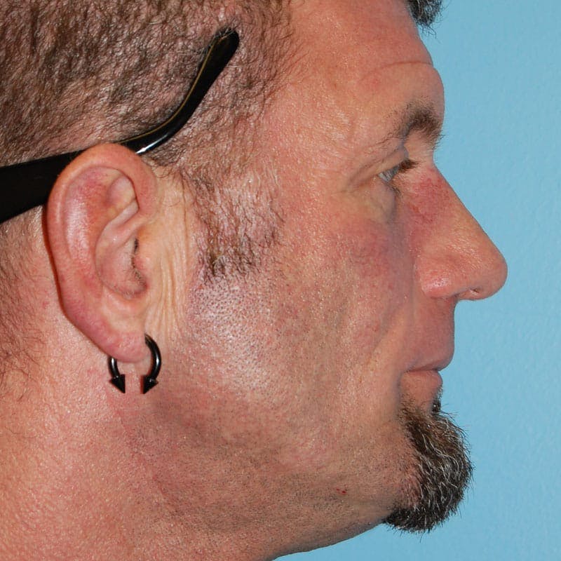Male Rhinoplasty Before & After Gallery - Patient 821686 - Image 2