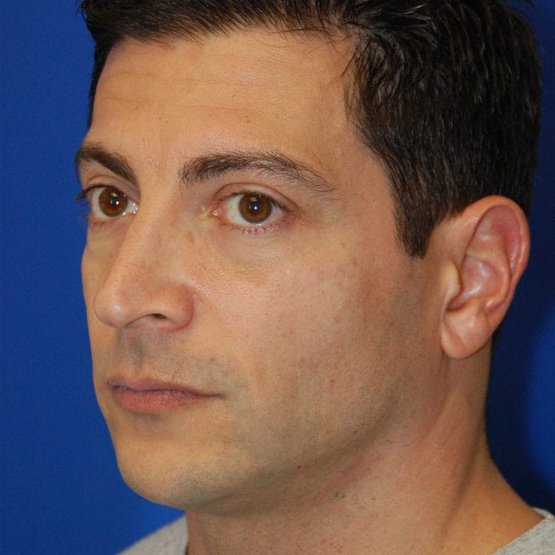 Male Rhinoplasty Before & After Gallery - Patient 372372 - Image 5