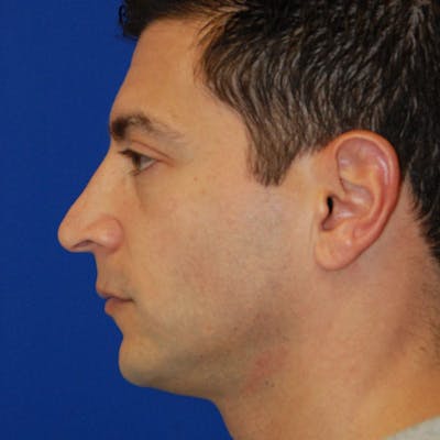 Male Rhinoplasty Before & After Gallery - Patient 372372 - Image 1