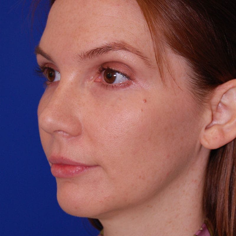 Female Rhinoplasty Before & After Gallery - Patient 179208 - Image 6