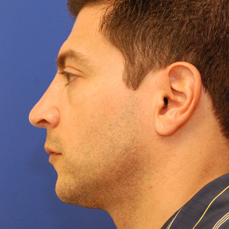 Male Rhinoplasty Before & After Gallery - Patient 372372 - Image 6