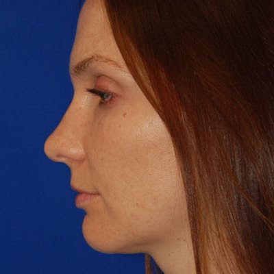 Female Rhinoplasty Before & After Gallery - Patient 179208 - Image 1