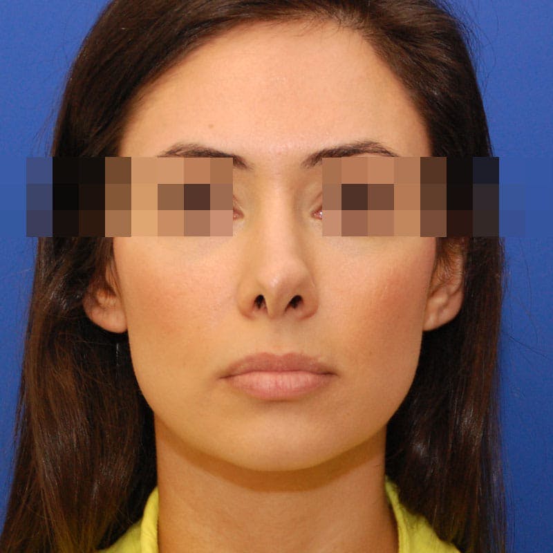 Revision Rhinoplasty Before & After Gallery - Patient 282897 - Image 3