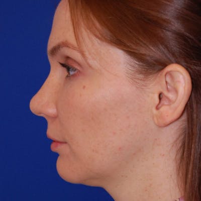 Female Rhinoplasty Before & After Gallery - Patient 179208 - Image 2