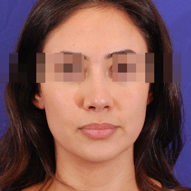 Revision Rhinoplasty Before & After Gallery - Patient 282897 - Image 4