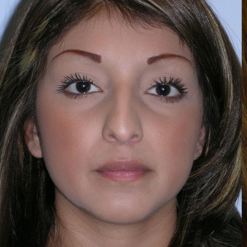 Female Rhinoplasty Before & After Gallery - Patient 282249 - Image 1