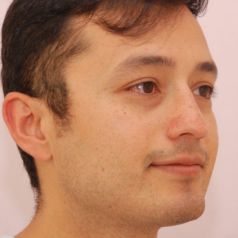 Male Rhinoplasty Before & After Gallery - Patient 254619 - Image 5
