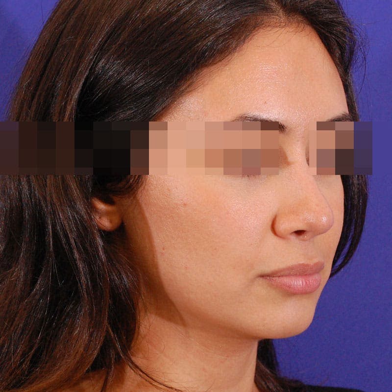 Revision Rhinoplasty Before & After Gallery - Patient 282897 - Image 6