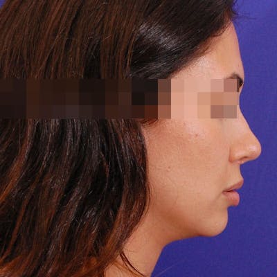 Revision Rhinoplasty Before & After Gallery - Patient 282897 - Image 2
