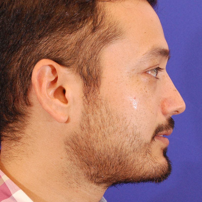 Male Rhinoplasty Before & After Gallery - Patient 254619 - Image 2