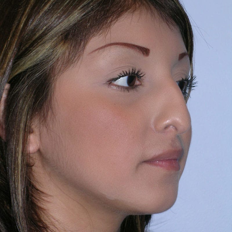 Female Rhinoplasty Before & After Gallery - Patient 282249 - Image 5