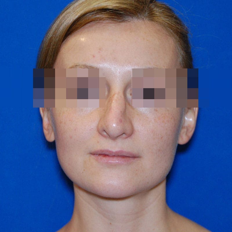 Revision Rhinoplasty Before & After Gallery - Patient 723800 - Image 3
