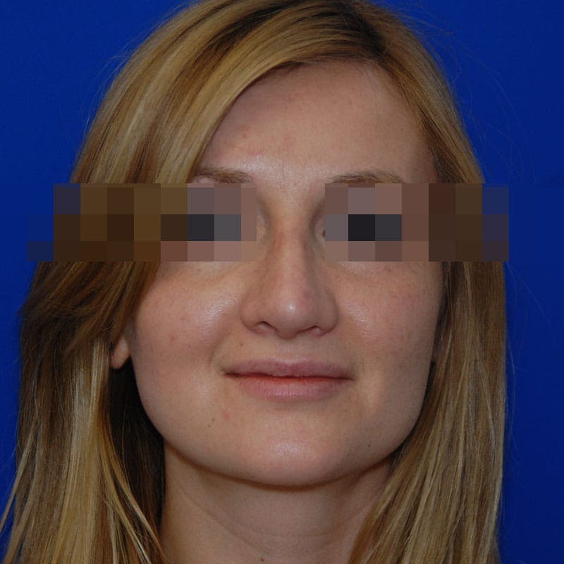 Revision Rhinoplasty Before & After Gallery - Patient 723800 - Image 4