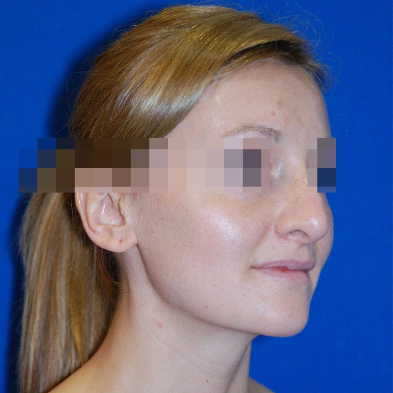 Revision Rhinoplasty Before & After Gallery - Patient 723800 - Image 5