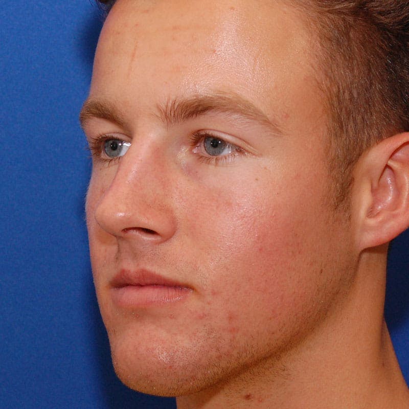 Male Rhinoplasty Before & After Gallery - Patient 858756 - Image 5