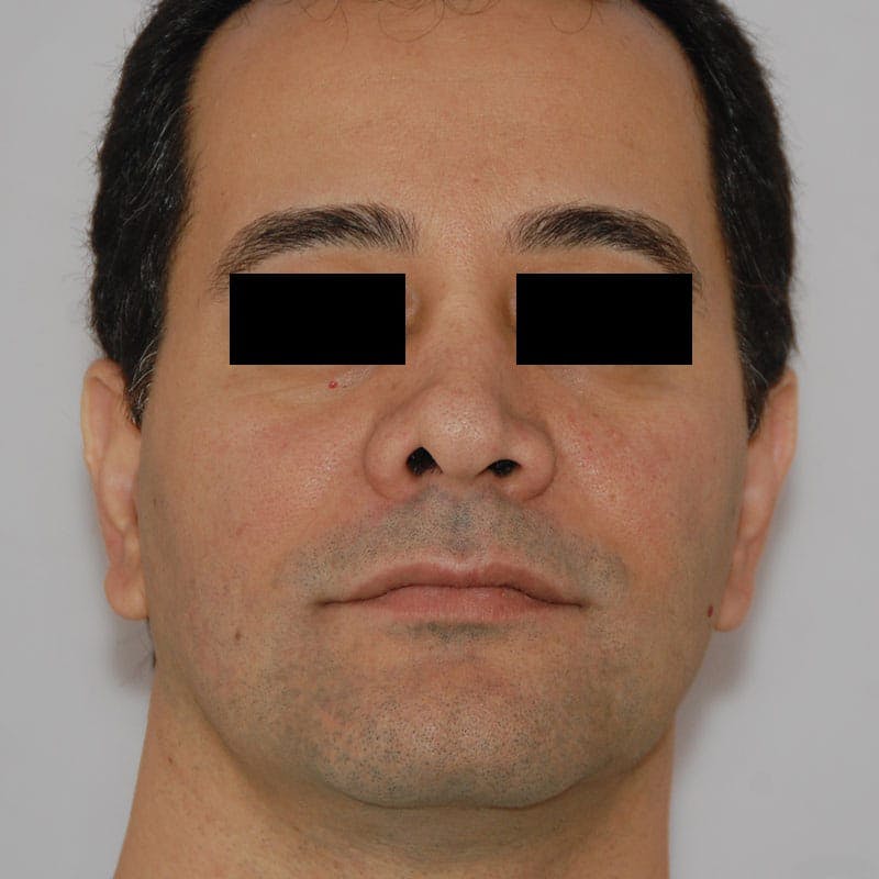 Ethnic Rhinoplasty Before & After Gallery - Patient 339377 - Image 1