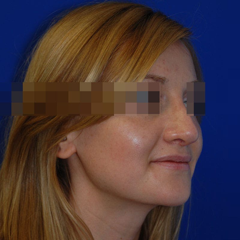 Revision Rhinoplasty Before & After Gallery - Patient 723800 - Image 6