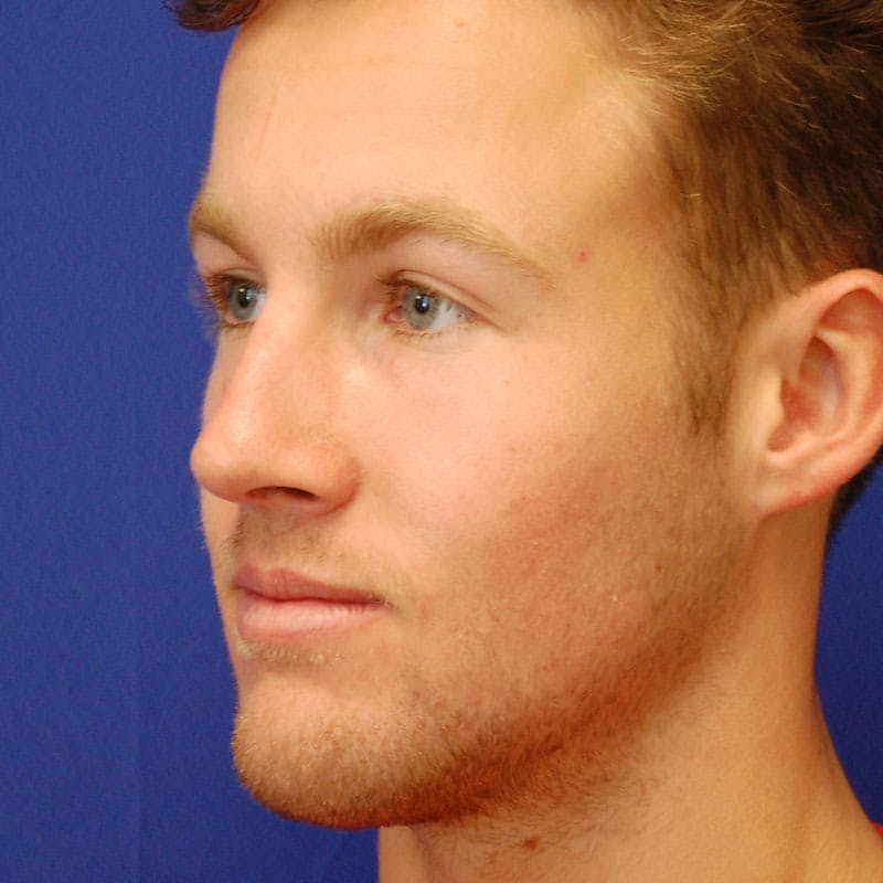 Male Rhinoplasty Before & After Gallery - Patient 858756 - Image 4