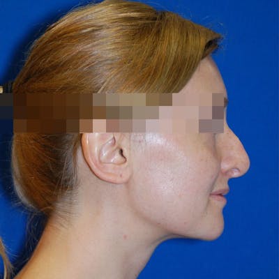 Revision Rhinoplasty Before & After Gallery - Patient 723800 - Image 1
