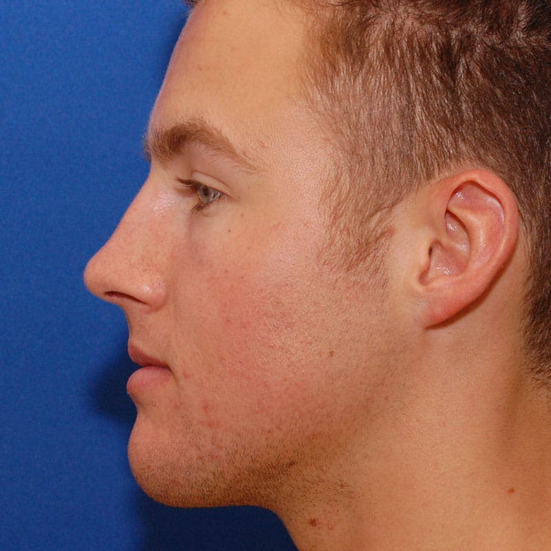 Male Rhinoplasty Before & After Gallery - Patient 858756 - Image 1