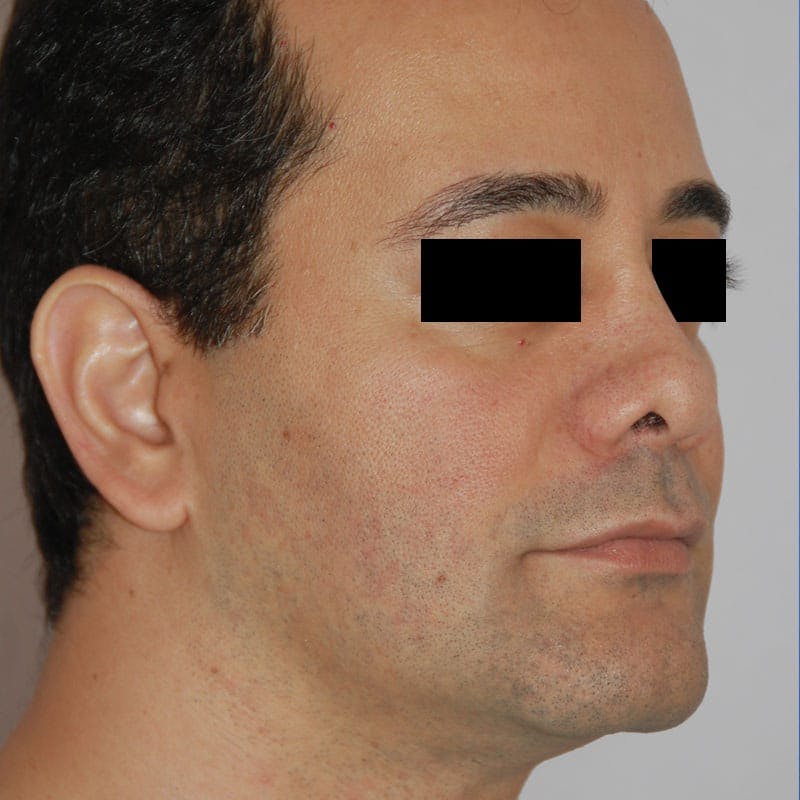Ethnic Rhinoplasty Before & After Gallery - Patient 339377 - Image 5
