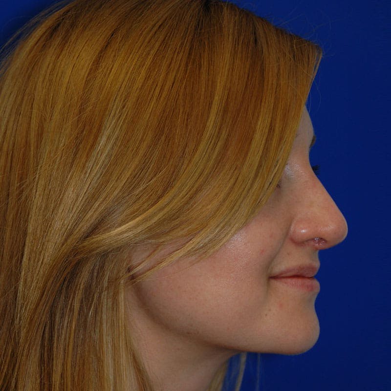 Revision Rhinoplasty Before & After Gallery - Patient 723800 - Image 6