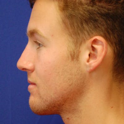 Male Rhinoplasty Before & After Gallery - Patient 858756 - Image 2