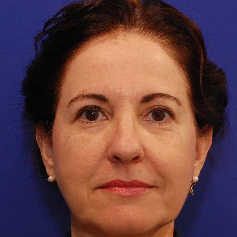 Facelift & Necklift Before & After Gallery - Patient 232659 - Image 1