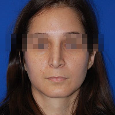 Revision Rhinoplasty Before & After Gallery - Patient 418567 - Image 1