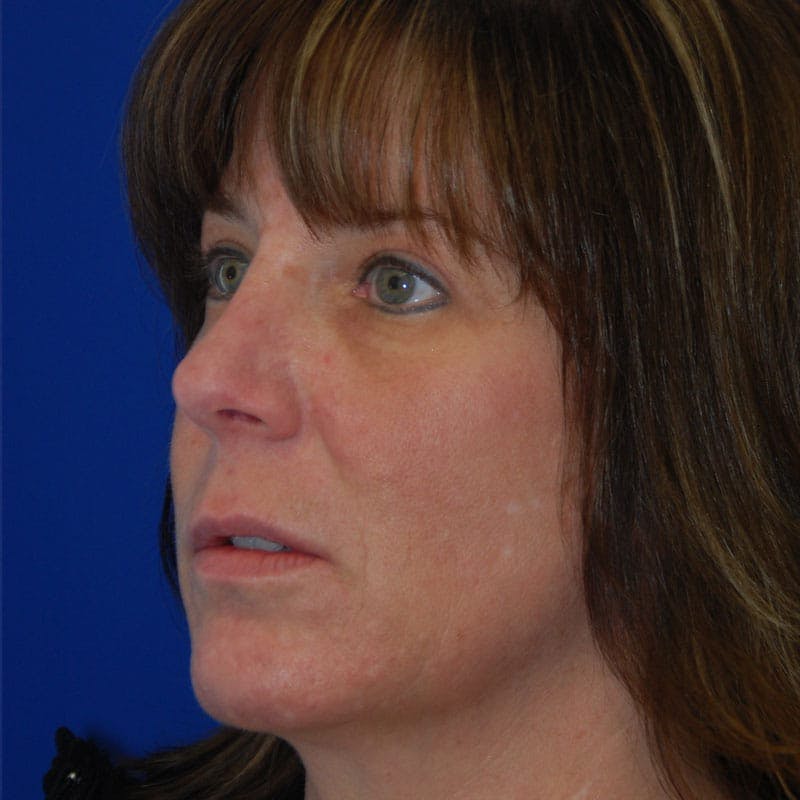 Female Rhinoplasty Before & After Gallery - Patient 115308 - Image 6
