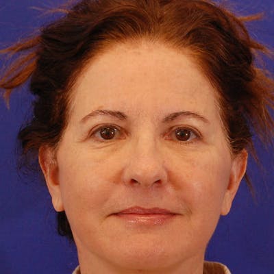 Facelift & Necklift Before & After Gallery - Patient 232659 - Image 2