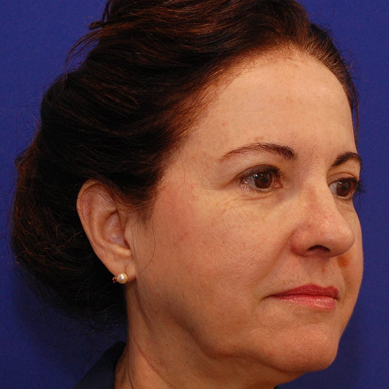 Facelift & Necklift Before & After Gallery - Patient 232659 - Image 3