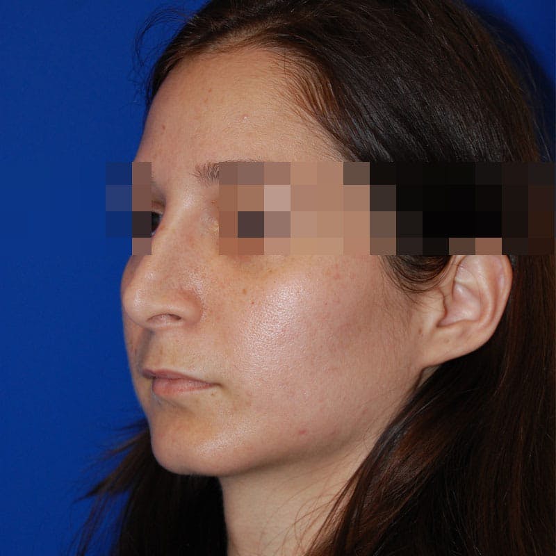 Revision Rhinoplasty Before & After Gallery - Patient 418567 - Image 5