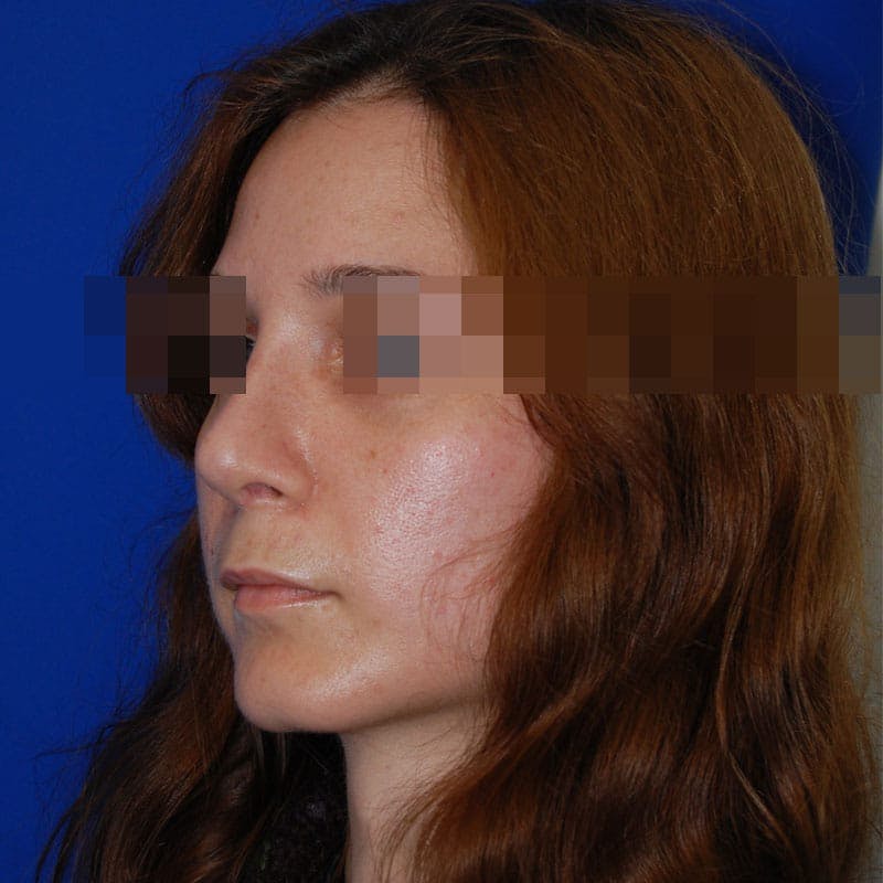 Revision Rhinoplasty Before & After Gallery - Patient 418567 - Image 6