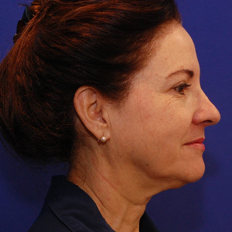 Facelift & Necklift Before & After Gallery - Patient 232659 - Image 5