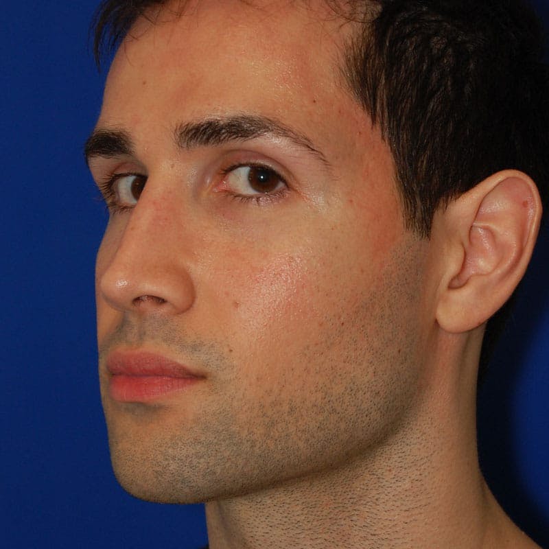 Male Rhinoplasty Before & After Gallery - Patient 175114 - Image 6