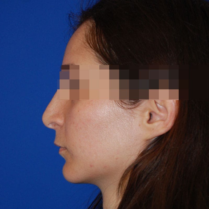 Revision Rhinoplasty Before & After Gallery - Patient 418567 - Image 1