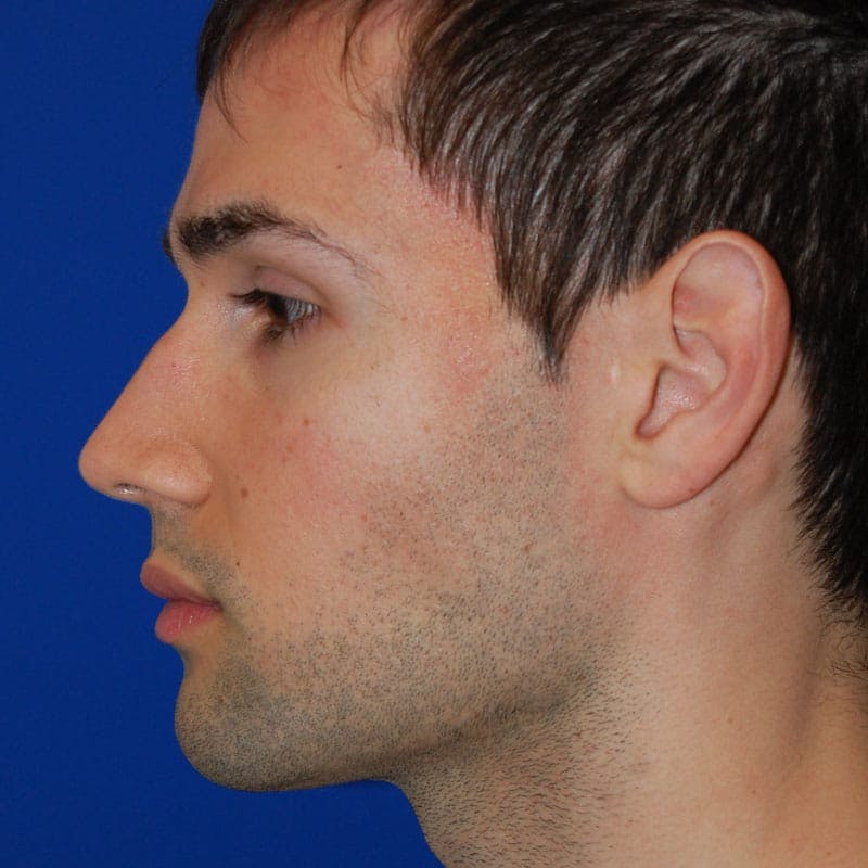 Male Rhinoplasty Before & After Gallery - Patient 175114 - Image 5