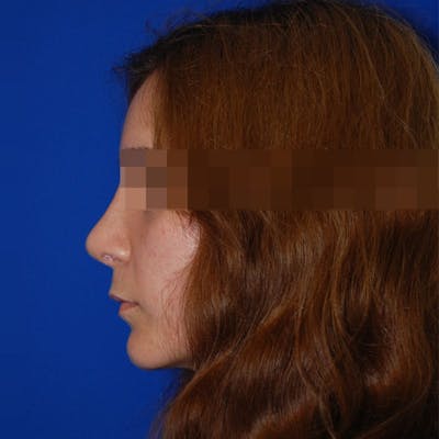 Revision Rhinoplasty Before & After Gallery - Patient 418567 - Image 2