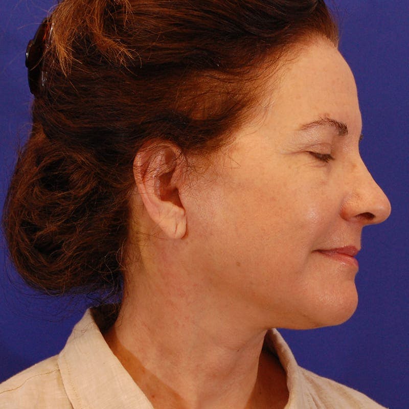 Facelift & Necklift Before & After Gallery - Patient 232659 - Image 6