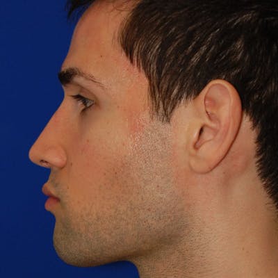 Male Rhinoplasty Before & After Gallery - Patient 175114 - Image 2