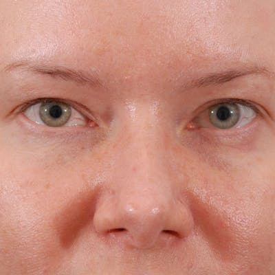 Upper Eyelid Surgery Before & After Gallery - Patient 547172 - Image 1