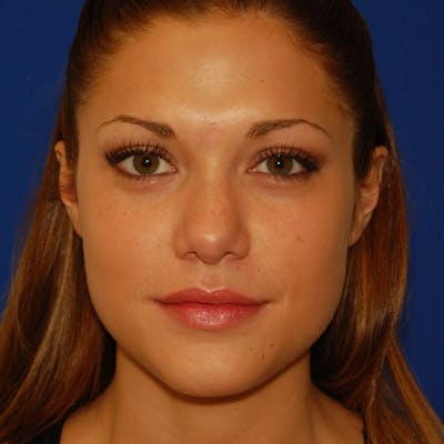 Revision Rhinoplasty Before & After Gallery - Patient 207501 - Image 1