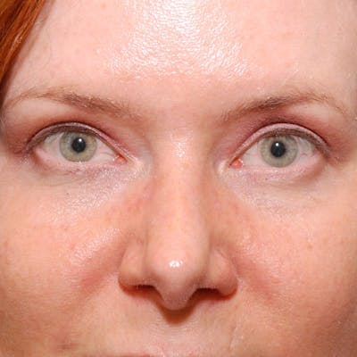Upper Eyelid Surgery Before & After Gallery - Patient 547172 - Image 2