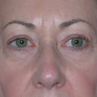 Lower Eyelid Surgery Before & After Gallery - Patient 390886 - Image 1