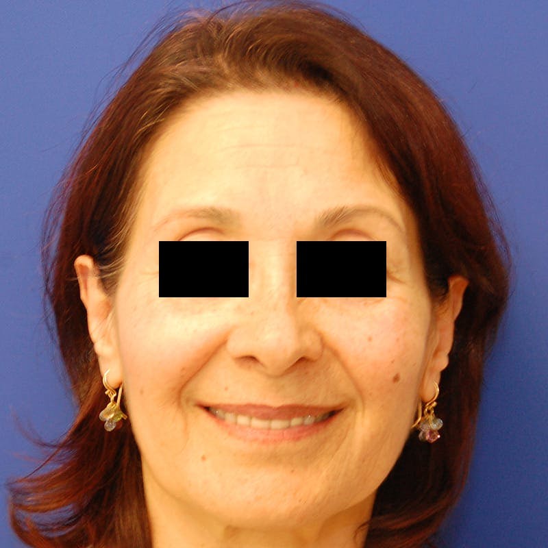 Facelift & Necklift Before & After Gallery - Patient 711850 - Image 1