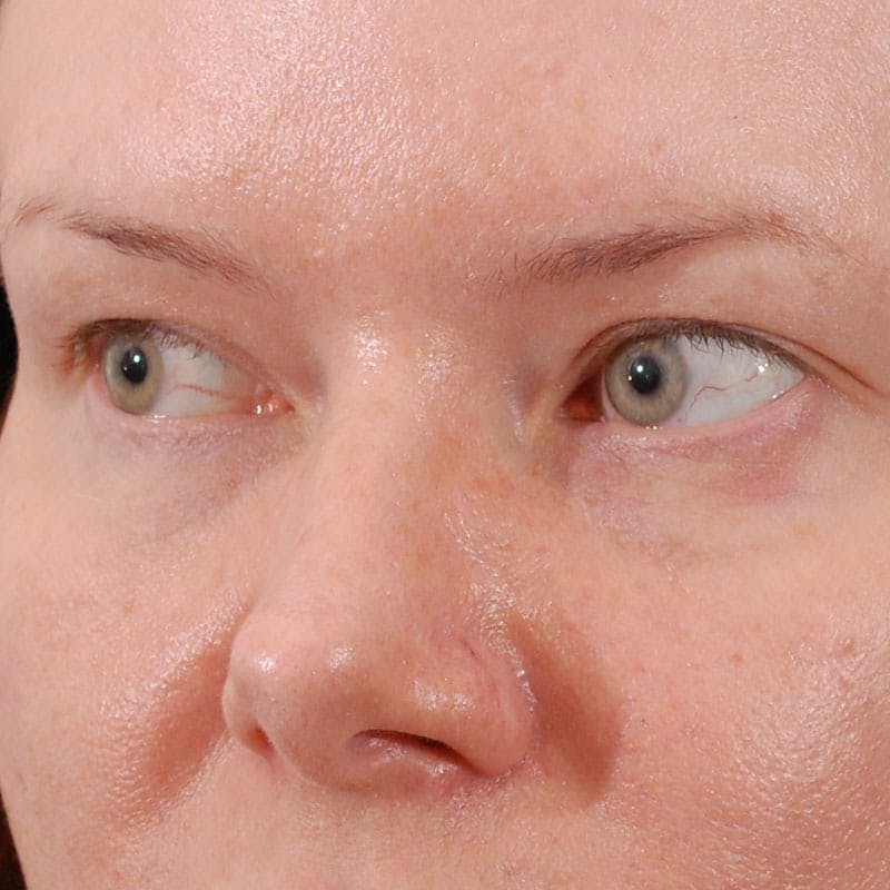 Upper Eyelid Surgery Before & After Gallery - Patient 547172 - Image 3